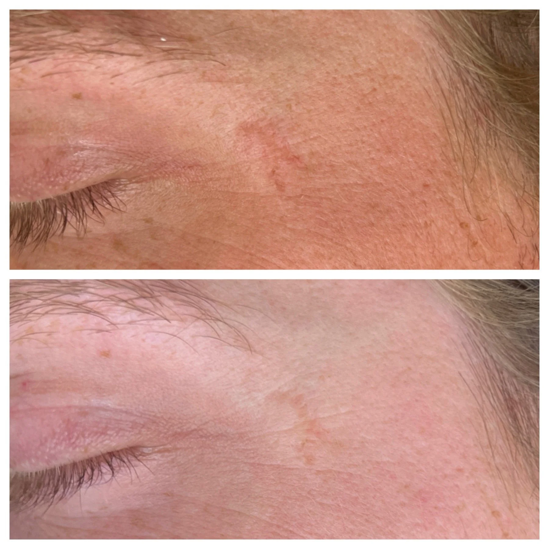 Close-up of a person's forehead showing the removal of skin blemishes or spots, with a comparison of skin condition before and after treatment.