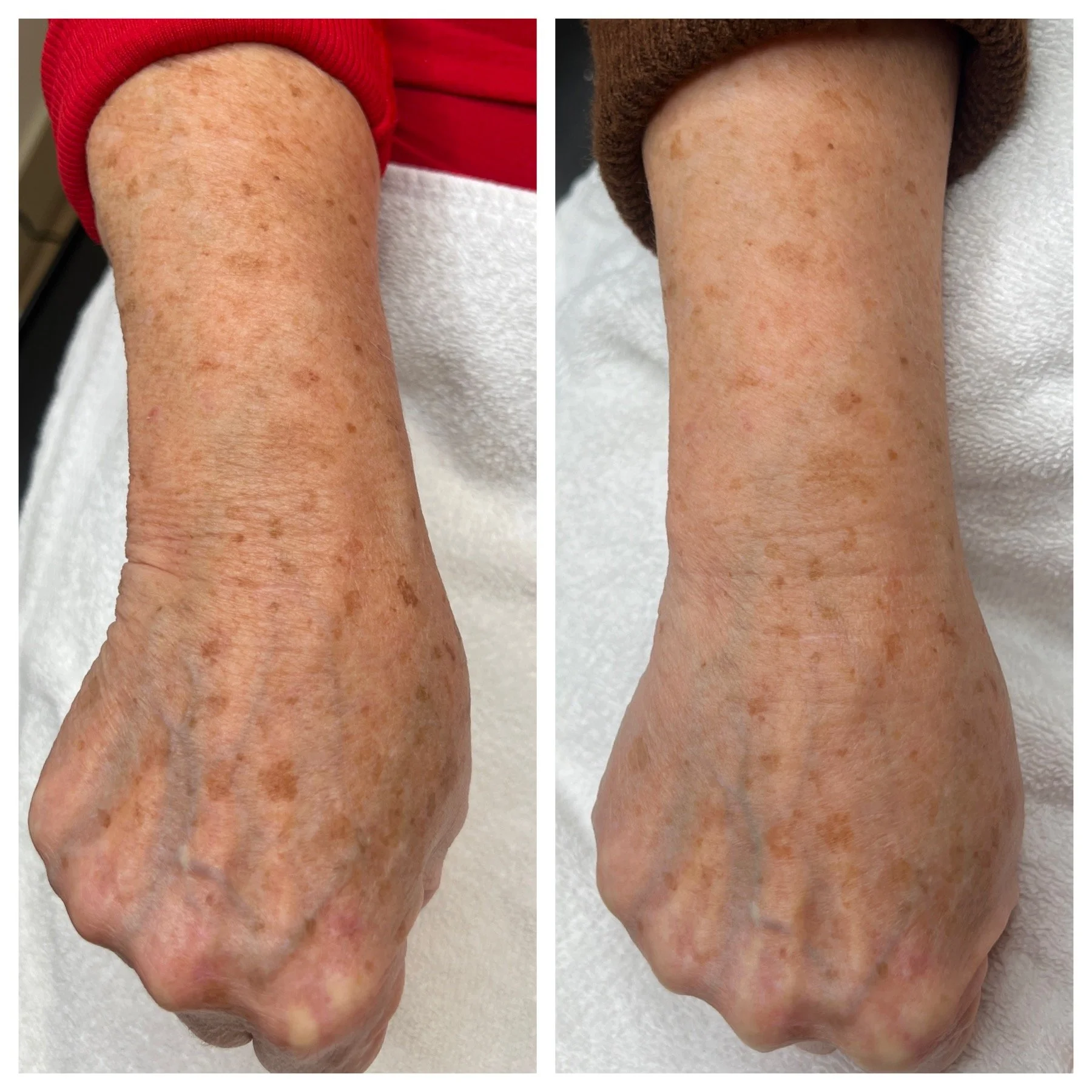 Before and after laser treatment for sun damage