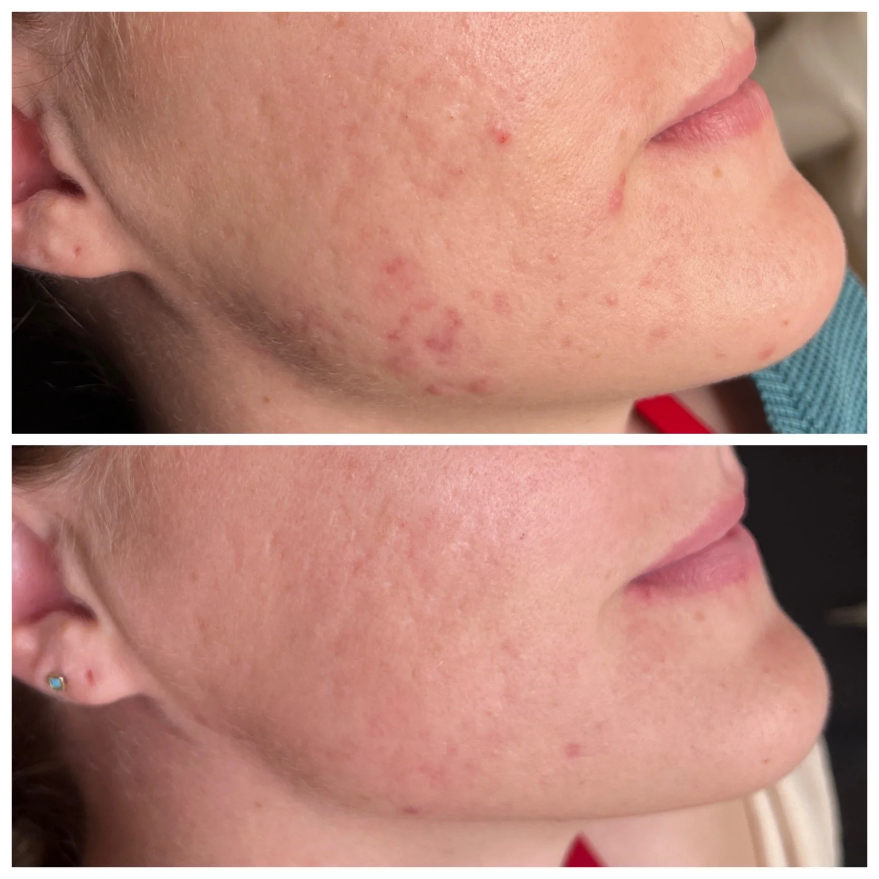 Before and after combination of ProCell and laser treatments