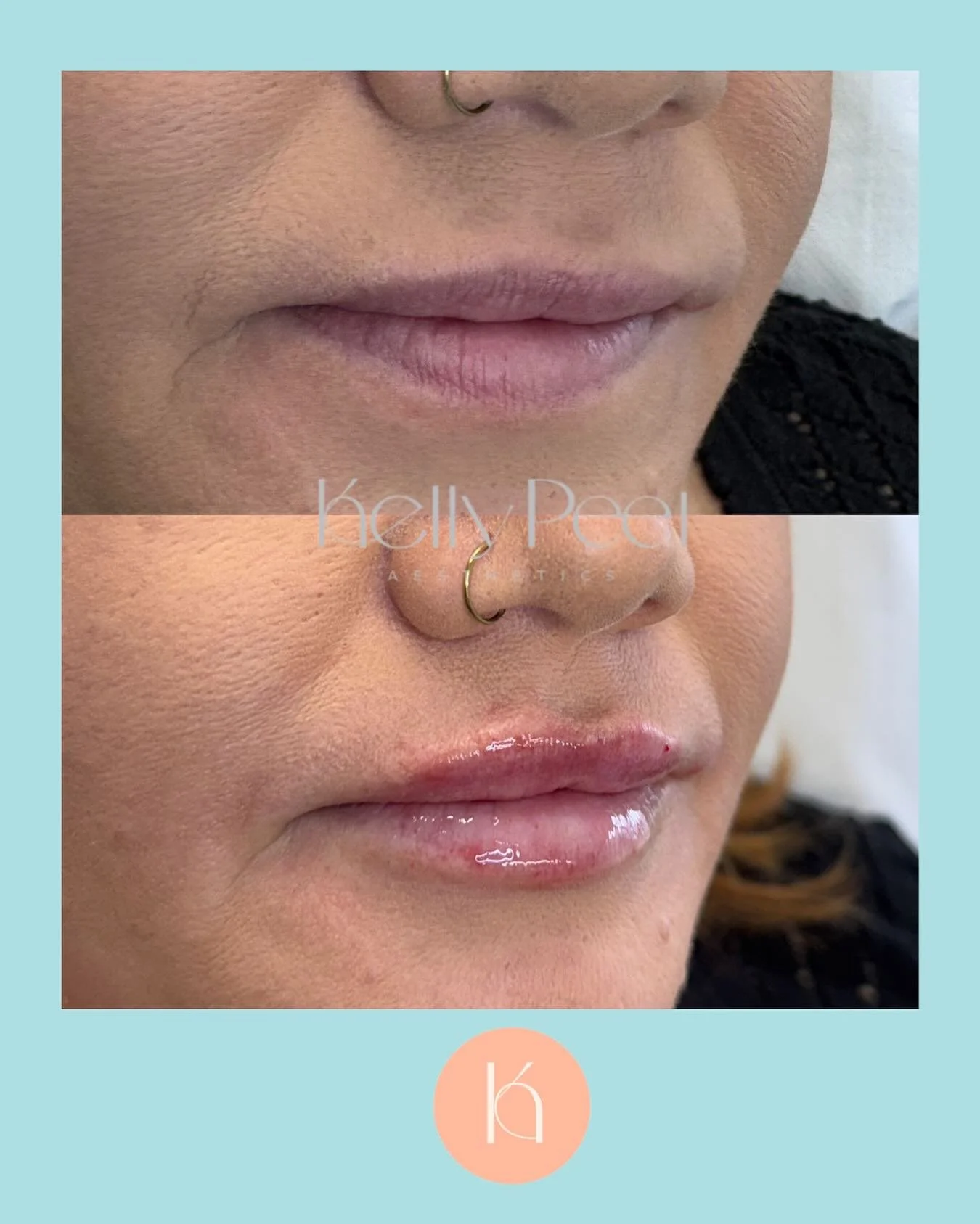 💫 Natural but noticeable.
For women who want their lips to look softly defined, not &ldquo;done.&rdquo;
Enhance shape, restore hydration, and keep your results beautifully natural.
📍Available in Reading
👩🏻&zwj;⚕️all treatments carried out by Regi