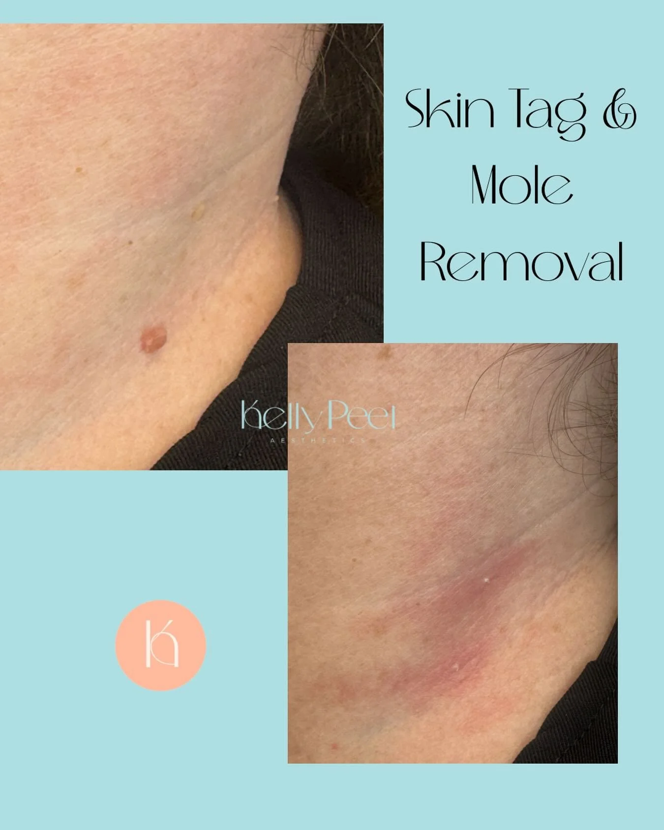 ✨ Before &amp; After: Mole &amp; Skin Tag Removal ✨
Unsightly? Irritating? Constantly catching on clothing or jewellery?
You don&rsquo;t have to put up with them.
Removal is quick, comfortable, and involves minimal downtime, most clients are surprise