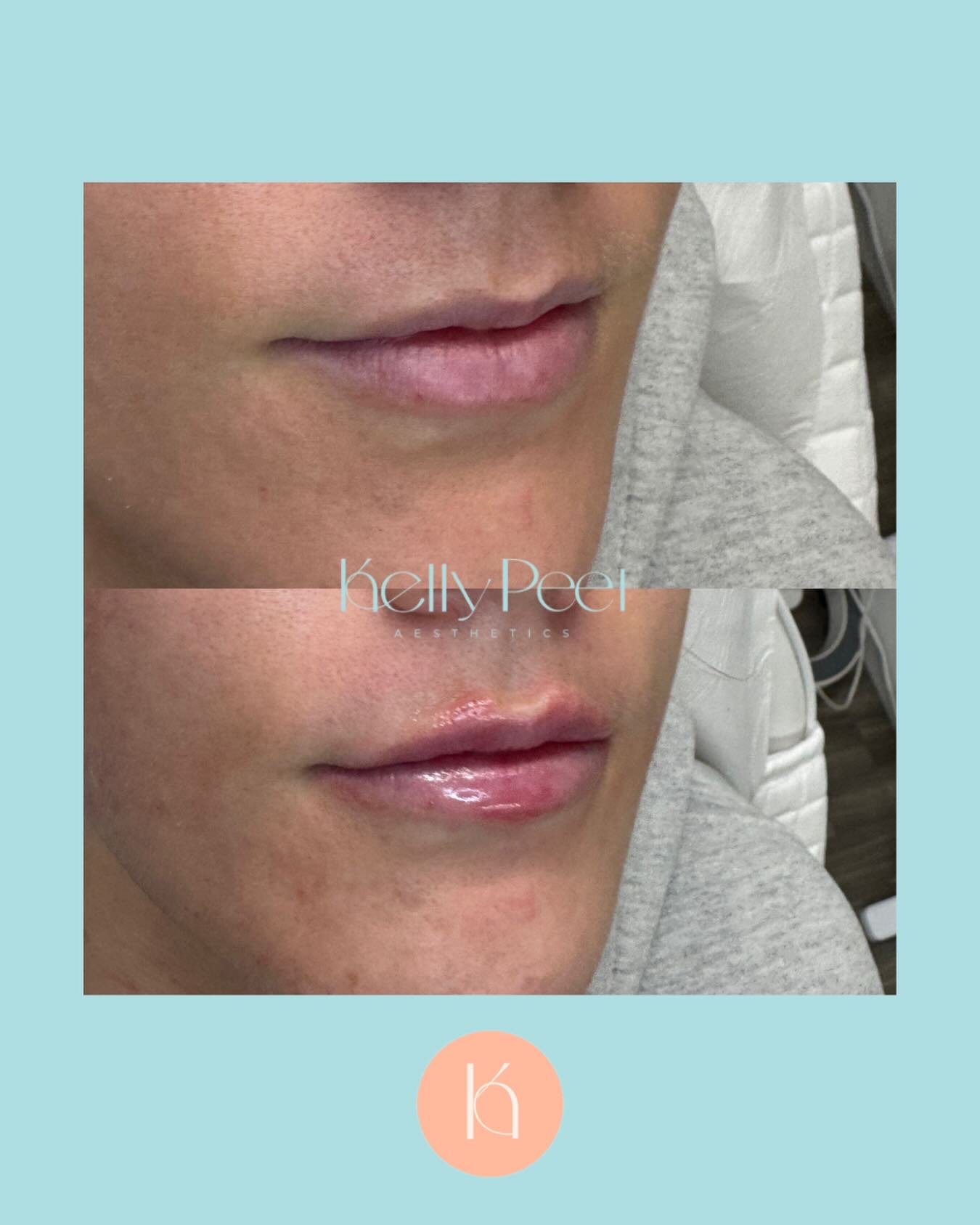 It wouldn&rsquo;t be valentines without some beautiful lips 🫦
&bull;
#juvedermlips #lipfiller #tilehurst #reading #berkshire