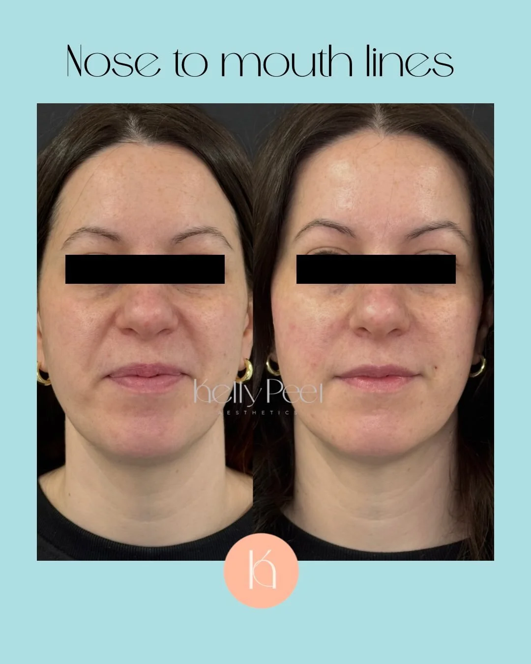 &ldquo;It&rsquo;s kind of there&hellip; but not.&rdquo; 💫
That was her exact reaction after her treatment, and honestly, that&rsquo;s the biggest compliment.

We didn&rsquo;t change her face.
We didn&rsquo;t add obvious volume.
We simply restored a 