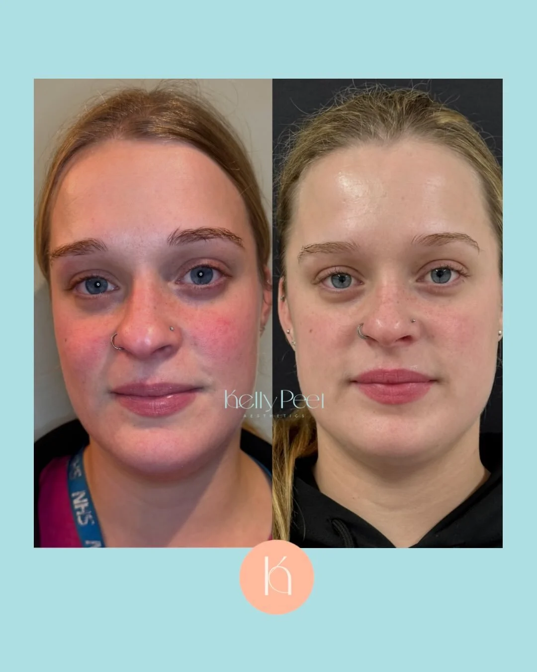 She came to me struggling with persistent redness at just 23.
Rosacea is a chronic condition, and it&rsquo;s often dismissed as something you just have to live with.
But with the right approach, focusing on calming inflammation and repairing the skin