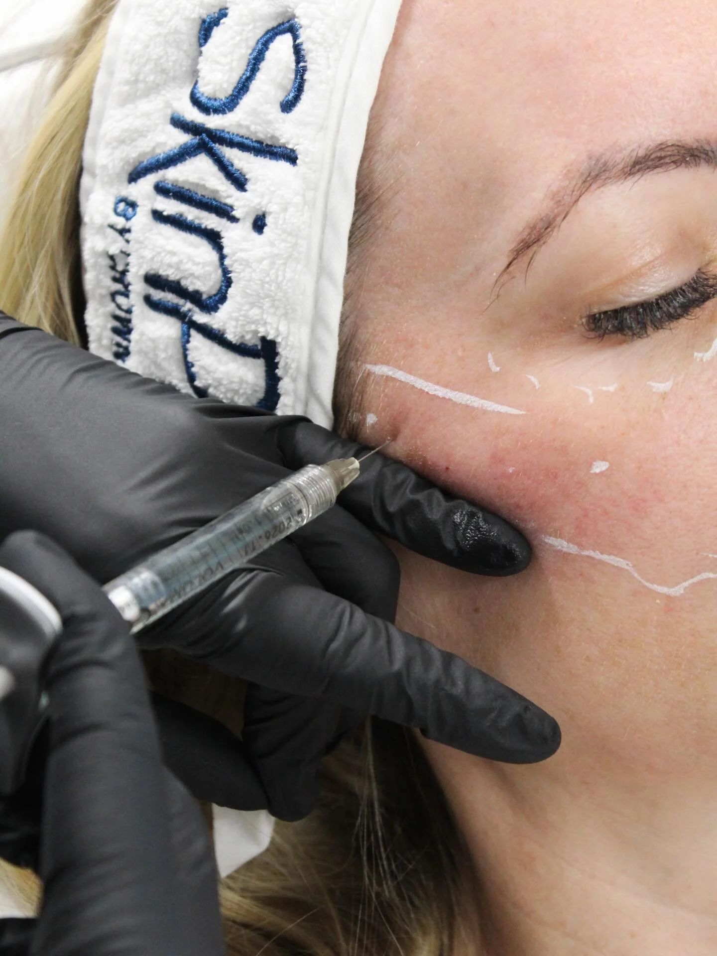 How quickly will you see results from your wrinkle-relaxing treatment? ✨

You can start to notice changes from 4&ndash;14 days, with full results visible at 2 weeks.

A follow-up appointment will be booked at 14 days to review your results and make s