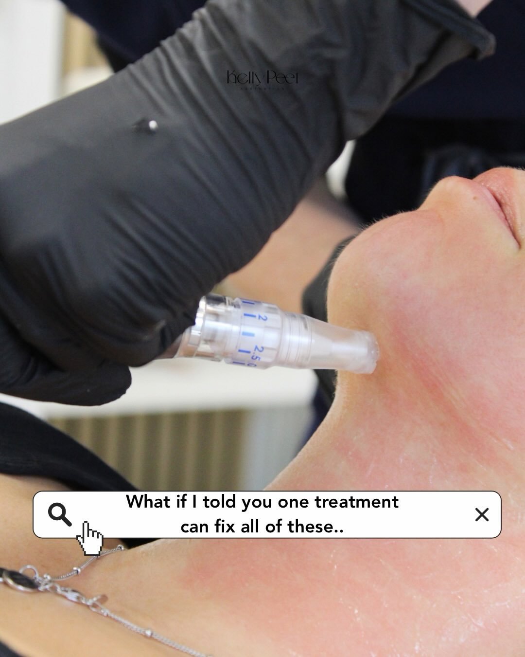 What if one treatment could target it all? ✨

From acne scarring and texture to enlarged pores, dull skin and fine lines&hellip; this is where real skin transformation begins.

Microneedling works by stimulating your natural collagen, helping you ach