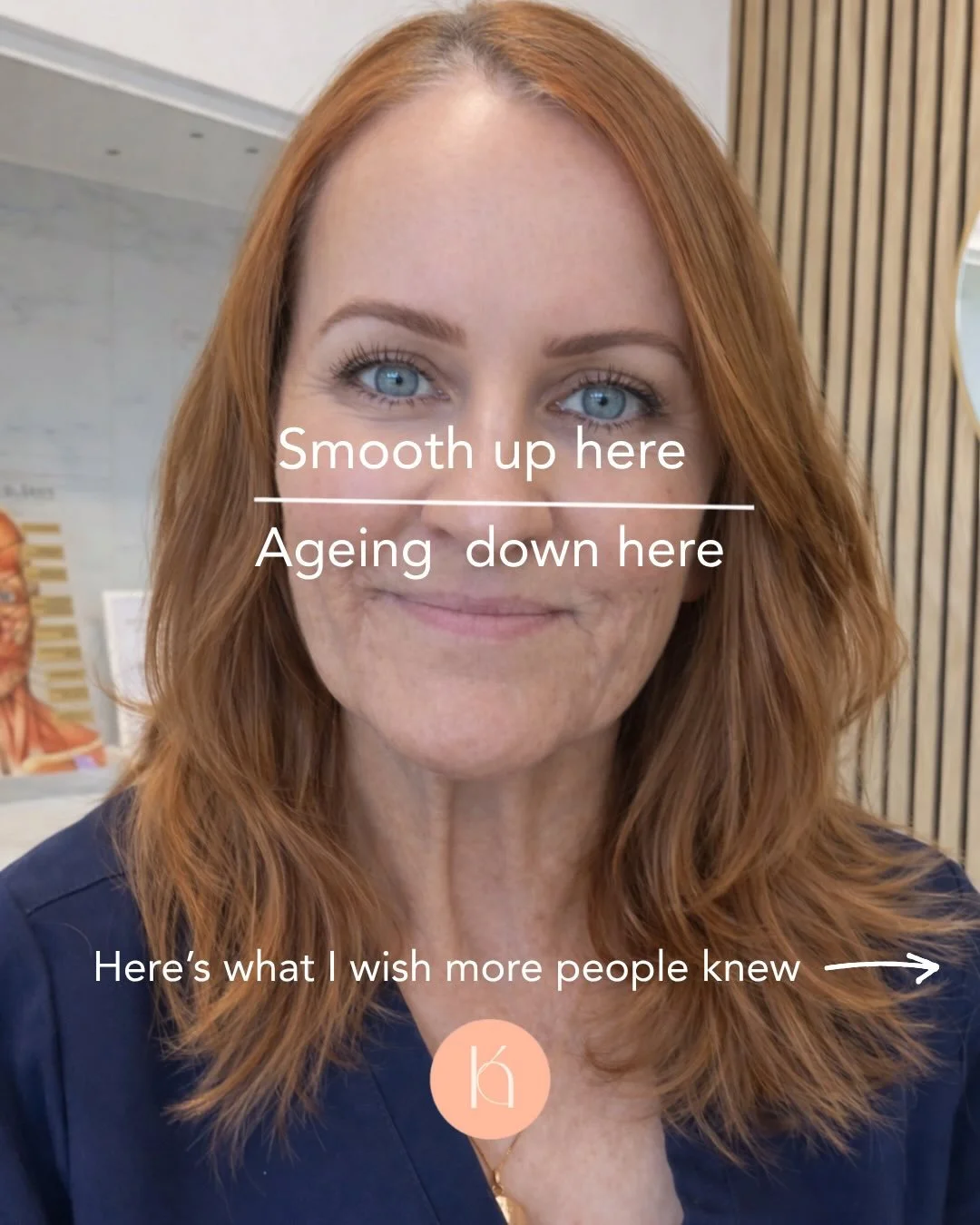 Don&rsquo;t have the forehead of a 25 year old and the jowls of a 60 year old because you&rsquo;re only treating the top of your face. 
&bull;
This is one of the most common things I see in people who have aesthetic treatments, and it&rsquo;s so easi