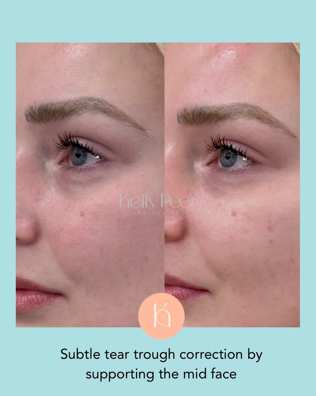 Subtle tear trough improvement by treating the mid-face
A smudge of cheek filler to restore support and soften under eye hollowing.
A natural, gentle first step, not an instant fix.
For optimal results, this will be combined with polynucleotides and 