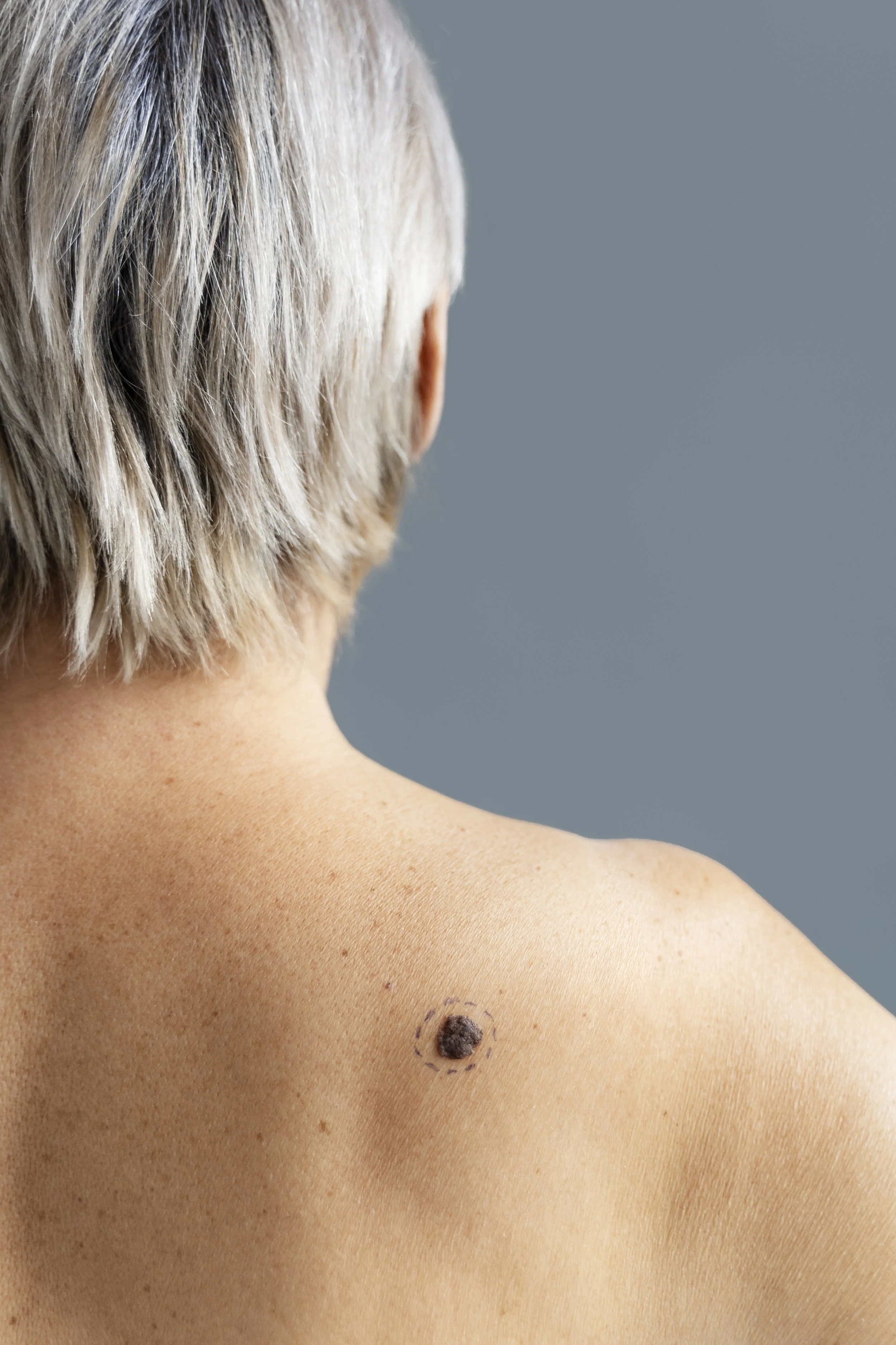 Melanoma Removal