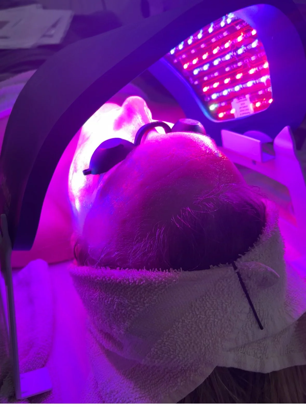 Person receiving LED light therapy facial treatment, lying on a towel with protective goggles, under a purple LED light mask in a spa or skincare clinic.