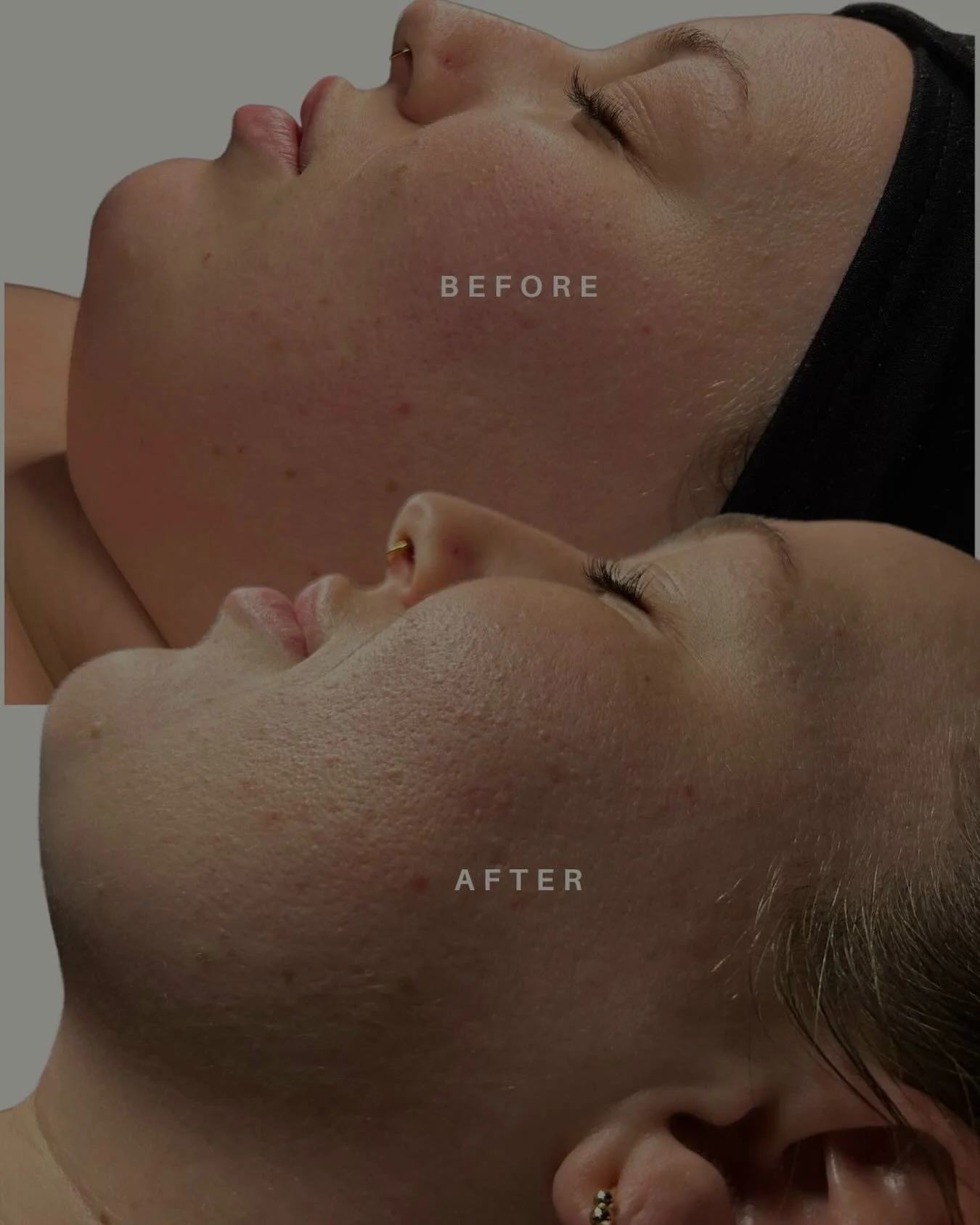 The results of 1 hour of lymphatic drainage and sculpting ✨

#ottawafacials #lymphaticdrainagemassage #facialmassage #buccalmassageottawa #facialsculpting
