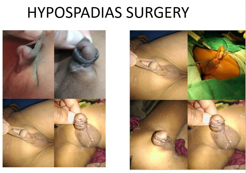 A collage depicting the process of hypospadias surgery with before and after images of a male genitalia, illustrating the surgical correction.
