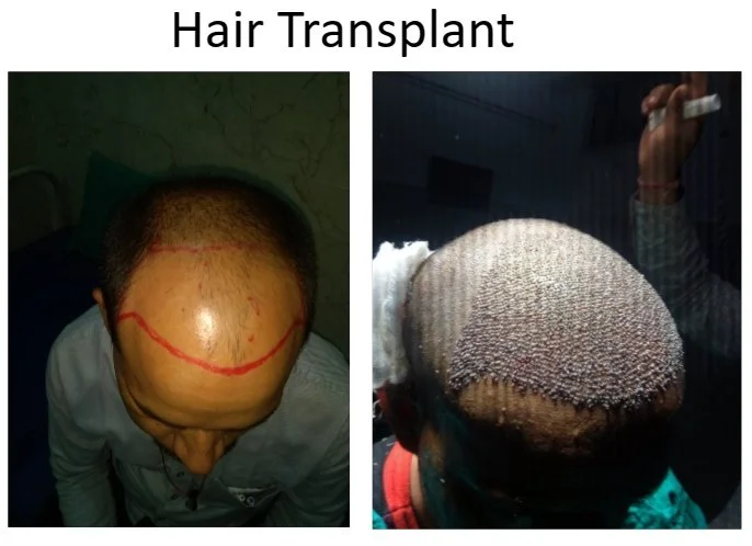 Comparison of before and after hair transplant procedures, showing a man's scalp with a surgical marking and a newly transplanted scalp with hair grafts.