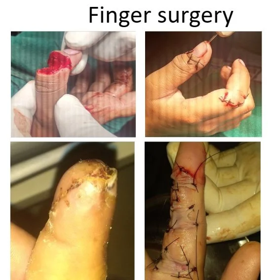 A collage showing different stages of finger surgery, including surgical procedures, stitches, and healing process of injured fingers.