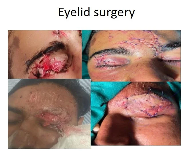 Compilation of four photos showing eyelid surgeries with stitches and healing scars.
