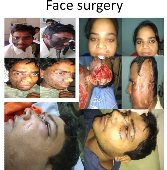 Series of photographs showing before and after images of face surgeries, including burn treatments, reconstructive procedures, and healing progress.