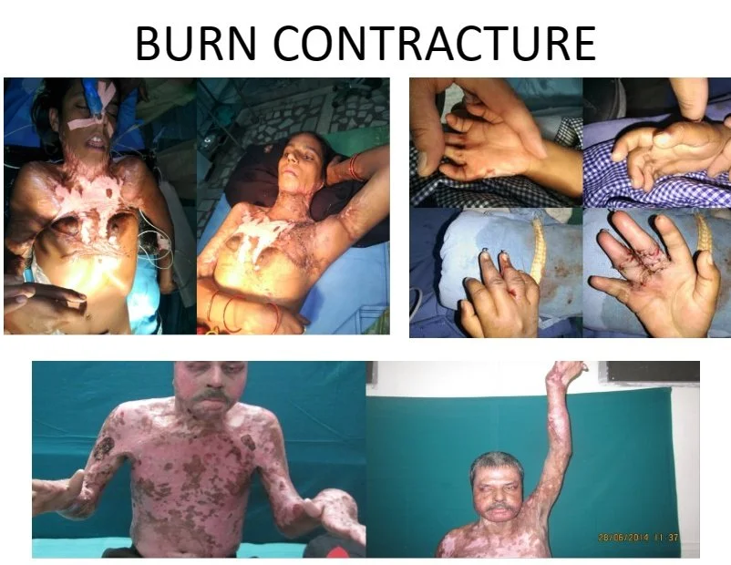 A collage showing photos of individuals with severe burns and burn injuries, including close-up of hands with burn scars, and patients with extensive burn injuries on their upper bodies.