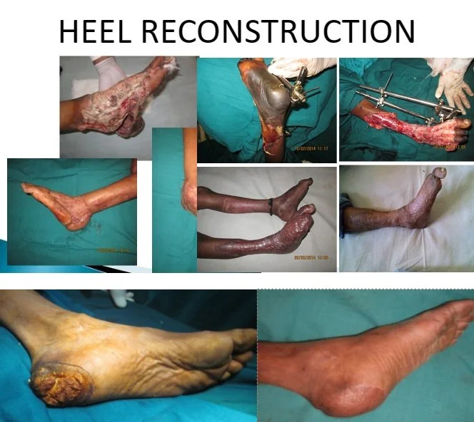 Collection of images showing heel reconstruction surgeries, including affected and surgical results on feet and legs.