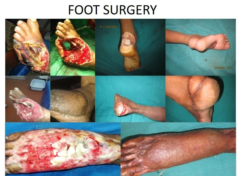 Compilation of images showing various stages and types of foot surgeries, including severe infections, wounds, and post-operative recoveries.