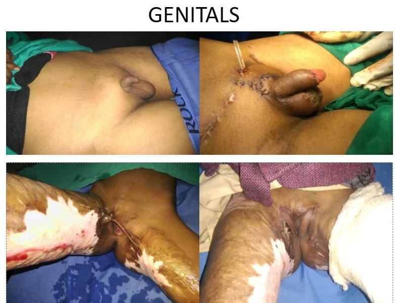 A collage showing medical images of male genital surgeries, including preoperative and postoperative views.