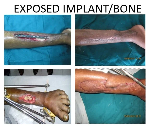 Compilation of four images showing a patient's leg with a visible implant or bone exposure. The images depict different stages of surgical treatment and wound healing on the patient's lower leg, which is positioned on a surgical drape with medical eq