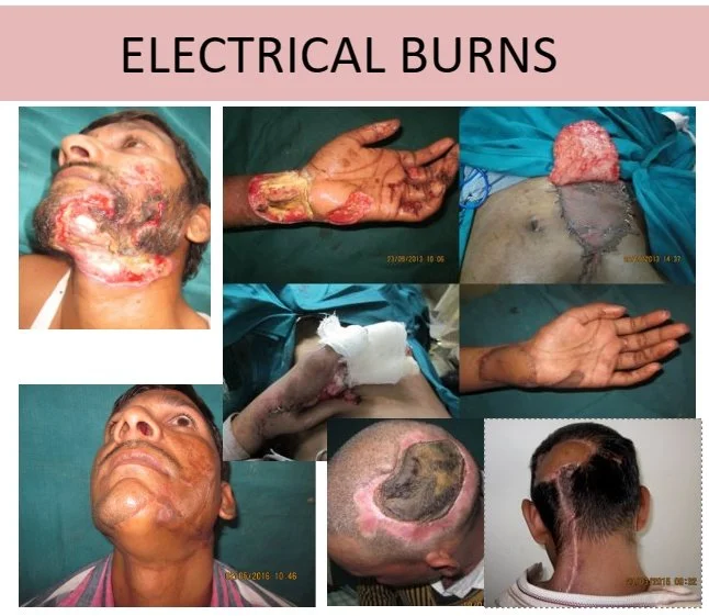 Collage of images showing victims with severe electrical burns on face, hands, and head, some with surgical wounds and skin grafts.