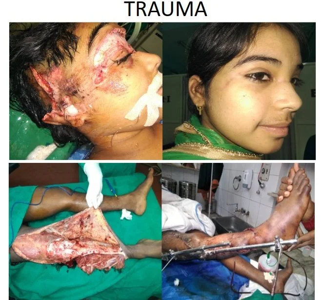 Compilation of four photos depicting trauma injuries. The top left shows a woman with severe facial burns and injuries. The top right shows a woman with a healed, intact face. The bottom left displays a patient with a large leg wound in a surgical se
