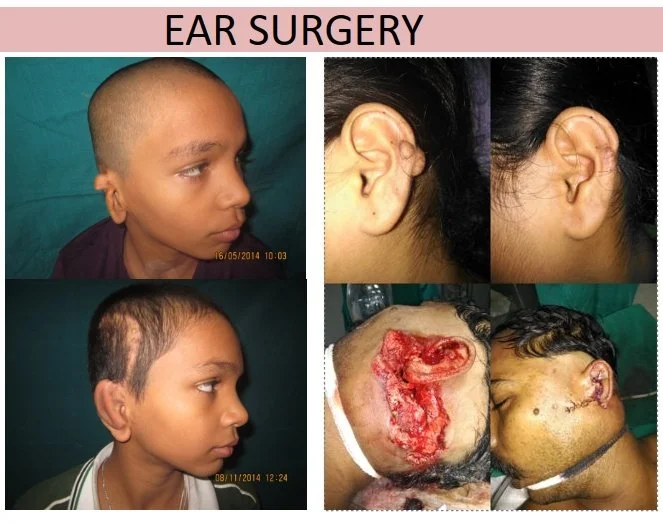 Compilation of images showing before-and-after photos of patients who underwent ear surgery, including the surgical procedures and results.