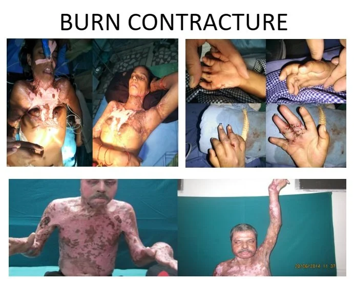 Compilation of images showing burn injuries and victims, including severe burns on arms, hands, and bodies, with one person raising an arm in a hospital setting.