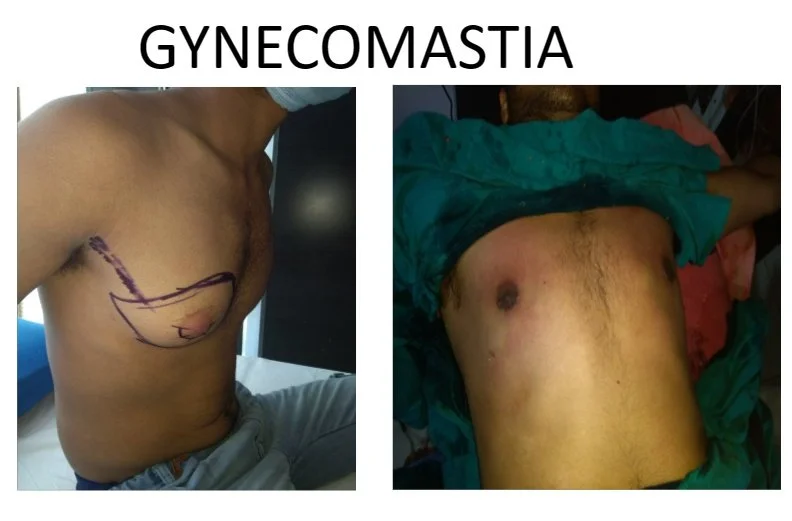 Image displaying two photos related to gynecomastia. The left photo shows a man's chest with surgical markings, indicating preparation for surgery. The right photo shows a man's chest post-surgery, with signs of medical treatment and healing.