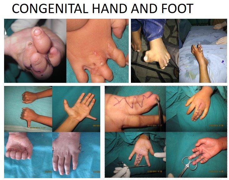 Collection of images showing various congenital hand and foot deformities, including mitten hand, rocker-bottom foot, polydactyly, syndactyly, and other limb anomalies.