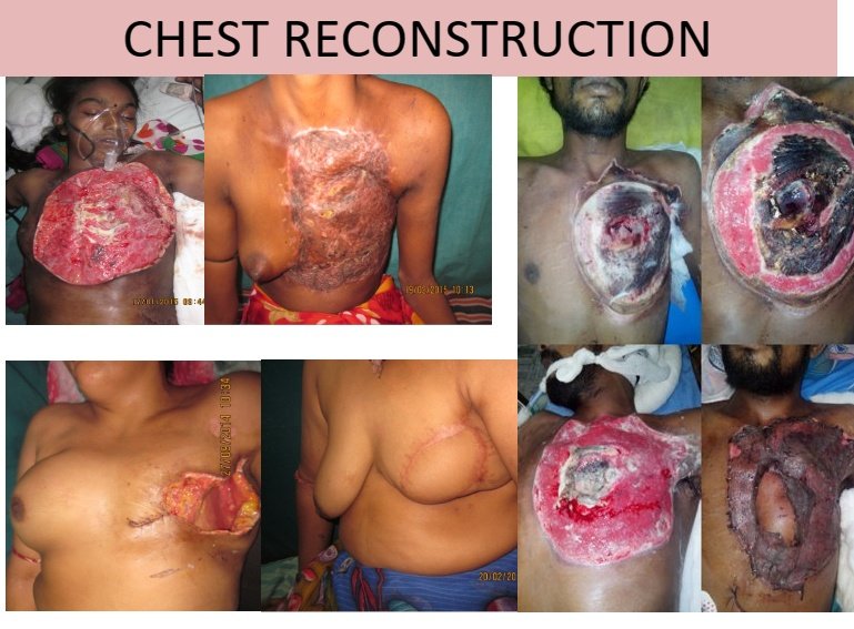 A collage of medical photos showing chest reconstruction procedures on different patients, with visible scars and reconstructed chest areas.