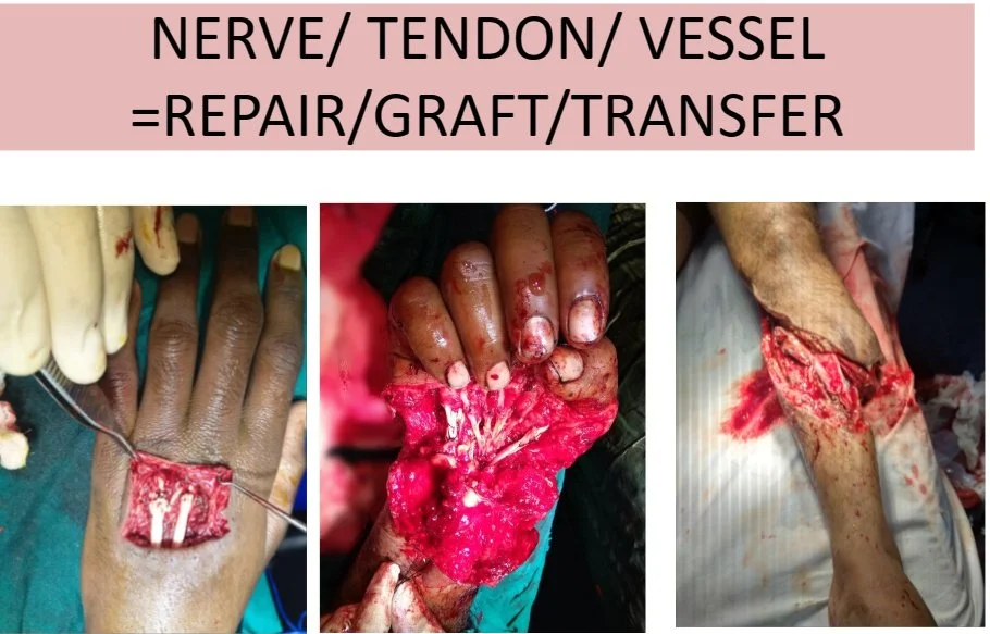 Images showing surgical procedures on hands and a leg, with signs of injury or trauma, accompanied by a sign about nerve, tendon, vessel repair, grafting, and transfer.