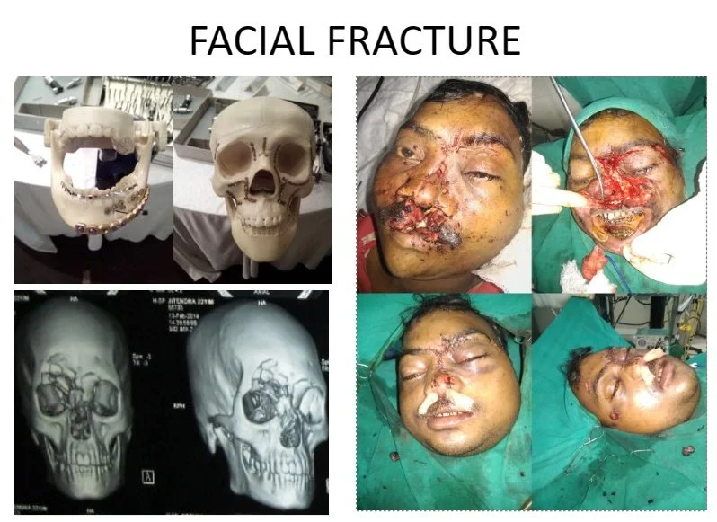 Images showing a facial fracture surgical procedure, including skull models, X-ray scans, and photos of a patient undergoing surgery with facial injuries.