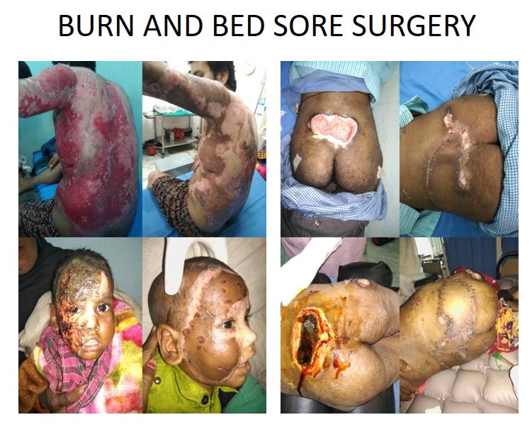 Compilation of images showing burn injuries and bedsores on children, with some wounds open or severely affected, in a medical setting.