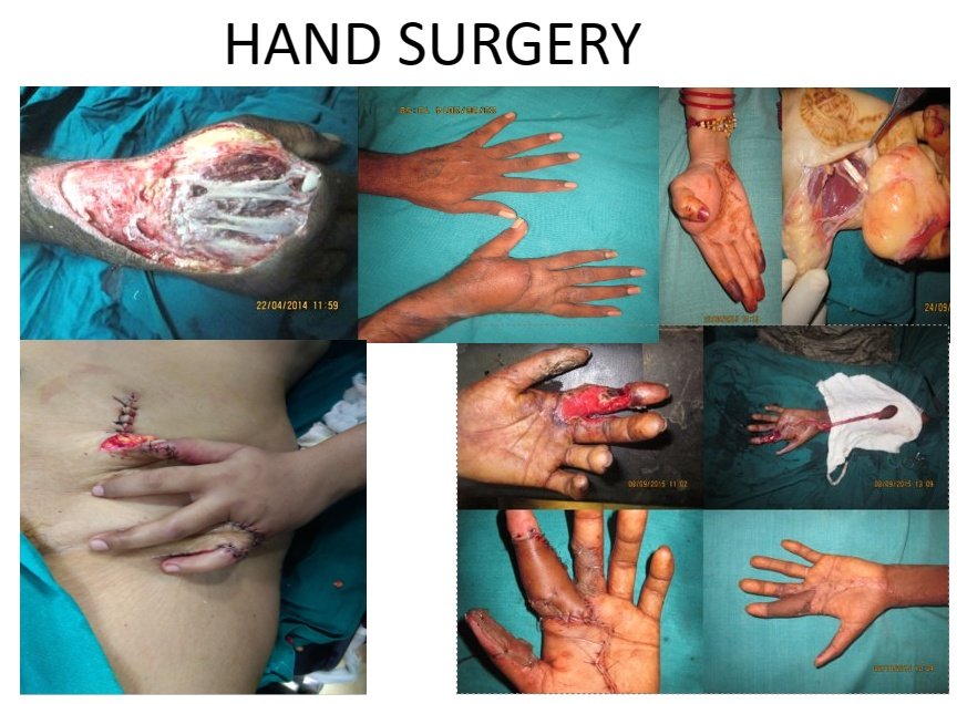 Collection of images showing hand surgical procedures and injuries, including amputations, wound treatments, and medical interventions related to hand surgery.