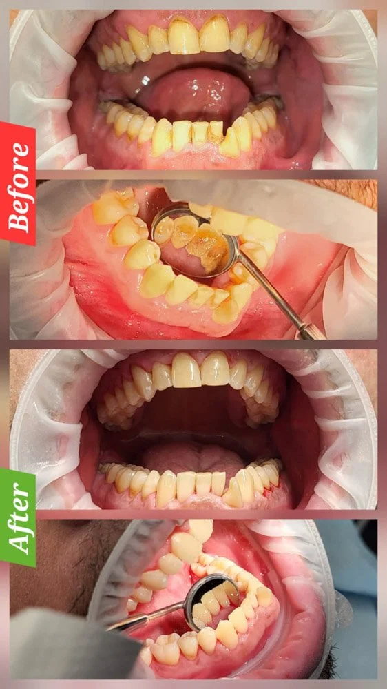 Before and after comparison showing tartar removal results from professional teeth cleaning