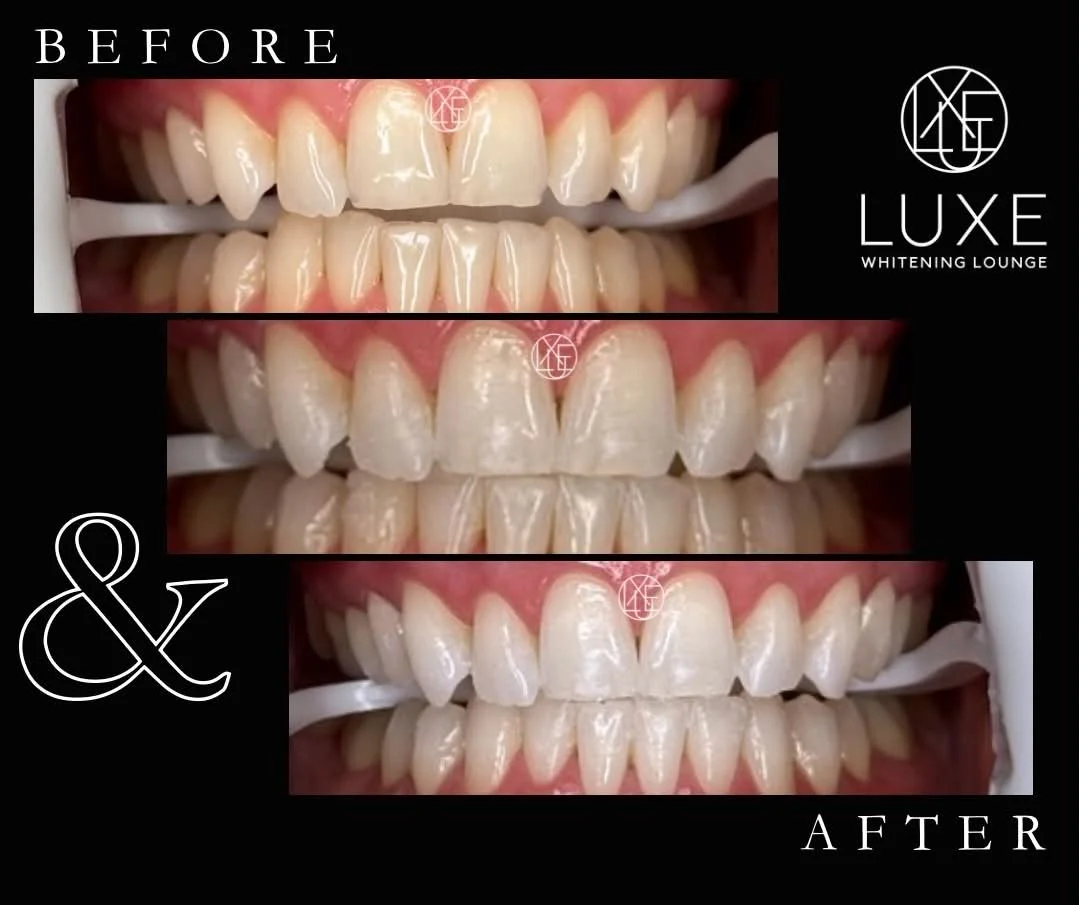 Set of three photographs showing teeth before and after whitening treatments, with a black background and white text indicating 'BEFORE' and 'AFTER'. The top image shows discolored teeth, the middle image shows some whitening progress, and the bottom