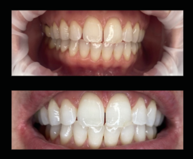 Comparison of teeth before and after whitening, showing improved brightness and stain removal.