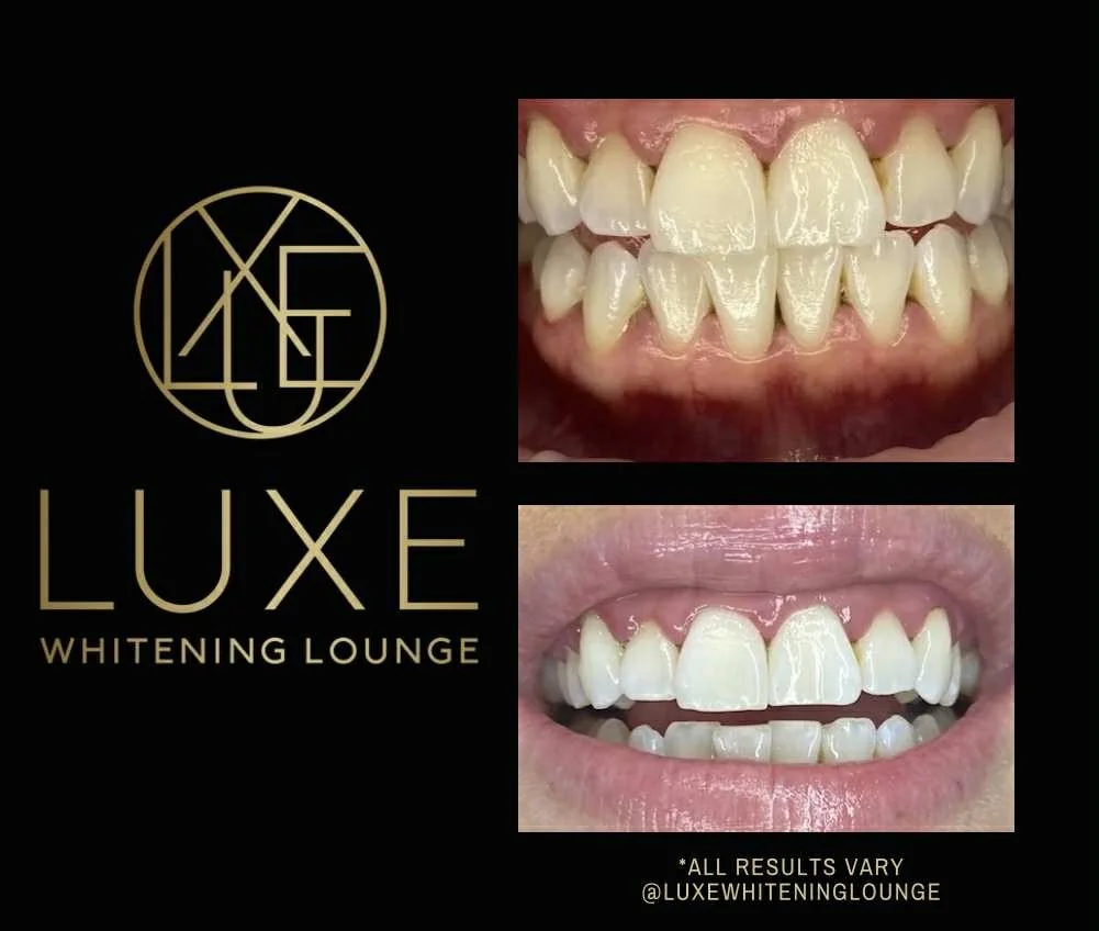 Comparison of teeth before and after teeth whitening at Luxe Whitening Lounge, showing significant improvement in teeth color and appearance.