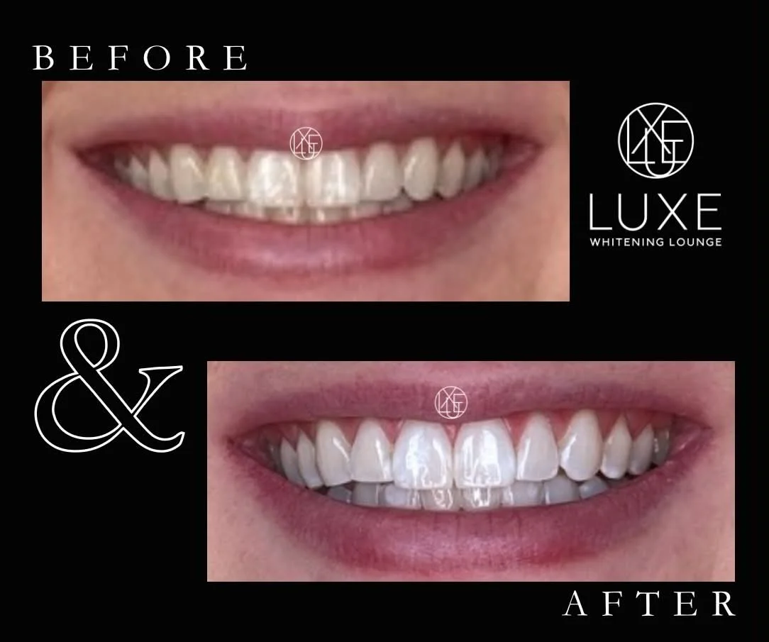 Professional teeth whitening results at LUXE Whitening Lounge