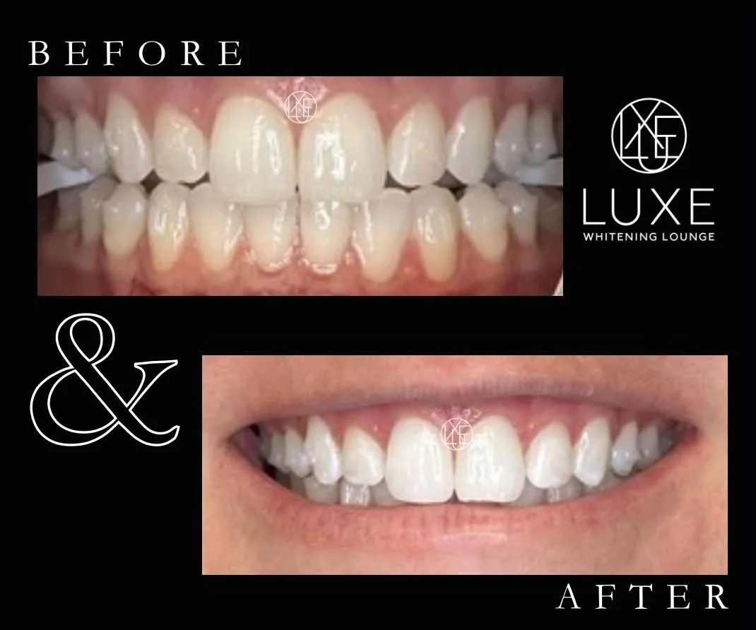 Comparison of teeth before and after whitening treatment, showing improved whiteness and appearance.