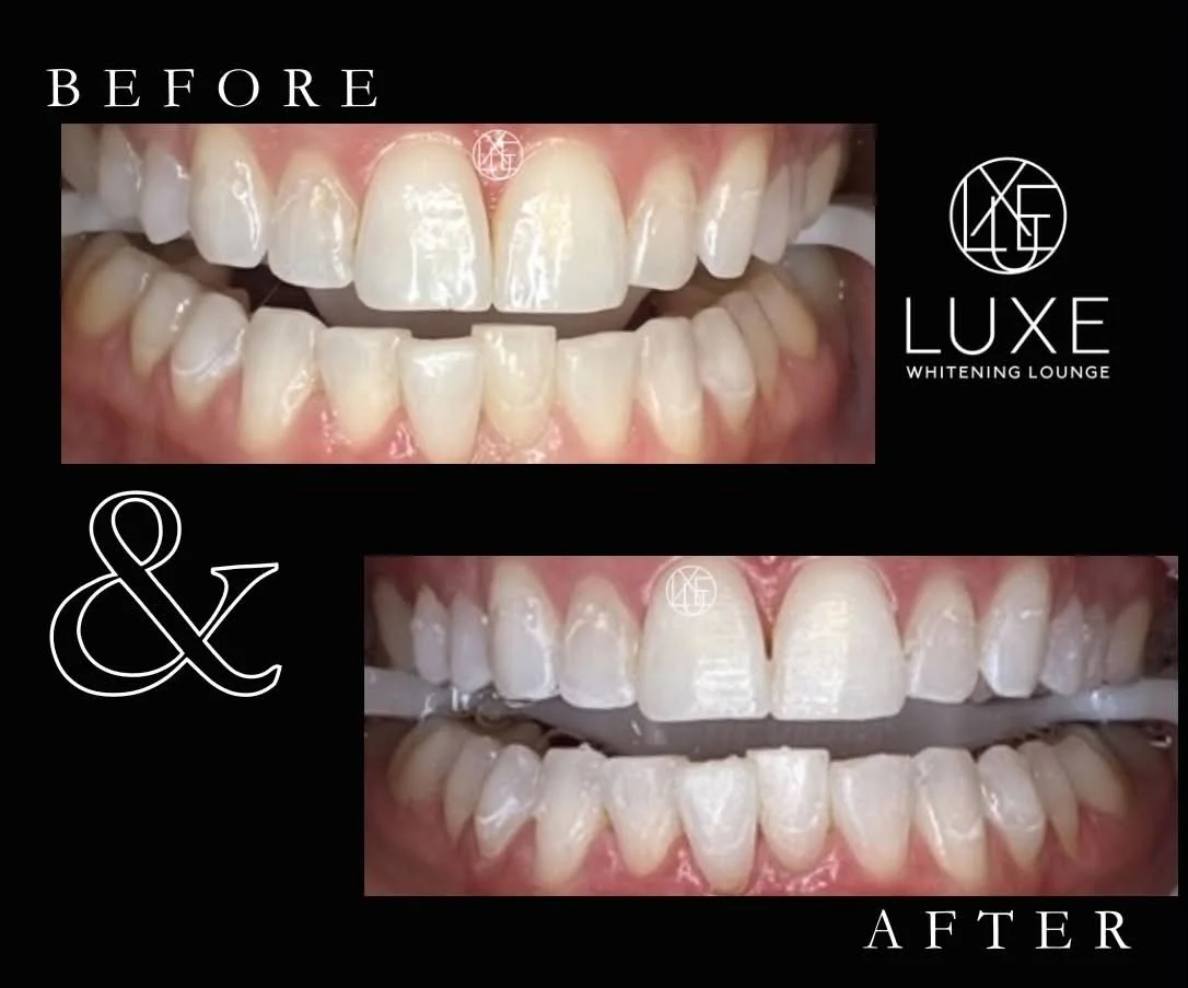 Comparison of teeth before and after whitening treatment, showing whiter teeth in the after image, with the 'Before' and 'After' labels and a teeth whitening lounge logo.
