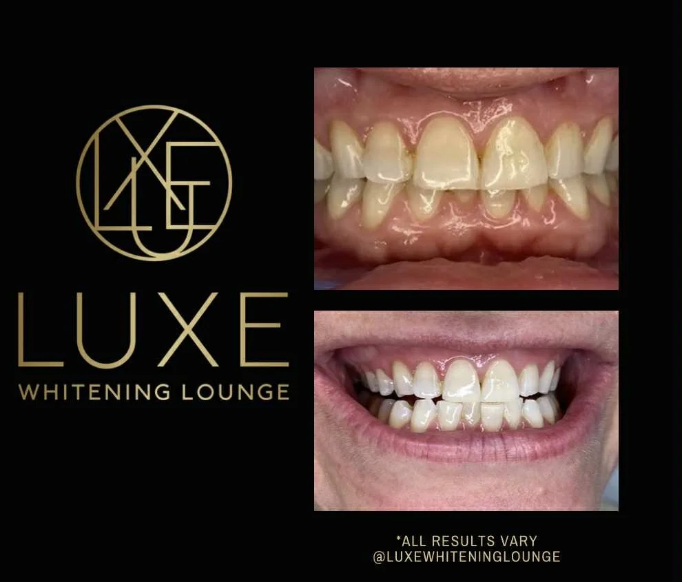 Comparison of teeth before and after whitening treatment, with a logo for Luxe Whitening Lounge and social media handle.