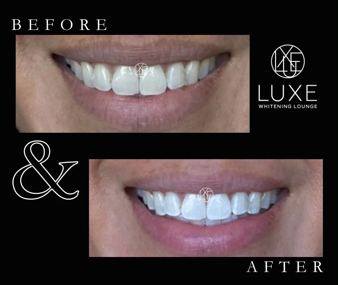 Comparison of a person's teeth before and after whitening treatment at Luxe Whitening Lounge, showing whiter teeth in the after image.
