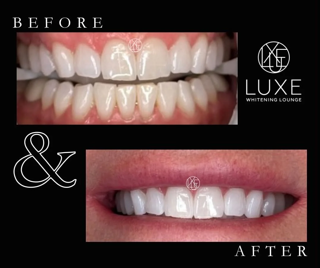 Comparison of teeth before and after whitening treatment, showing improved whiteness and brightness.