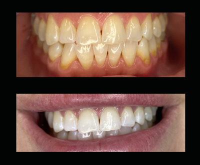 Comparison of two sets of teeth, with the top showing yellowed, uneven teeth and the bottom showing whiter, more aligned teeth.