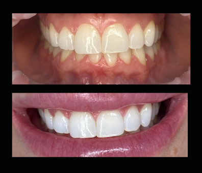 Comparison of teeth before and after whitening, showing improved brightness and stain removal.
