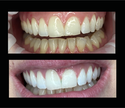 Comparison of teeth before and after whitening, showing improved brightness and stain removal.