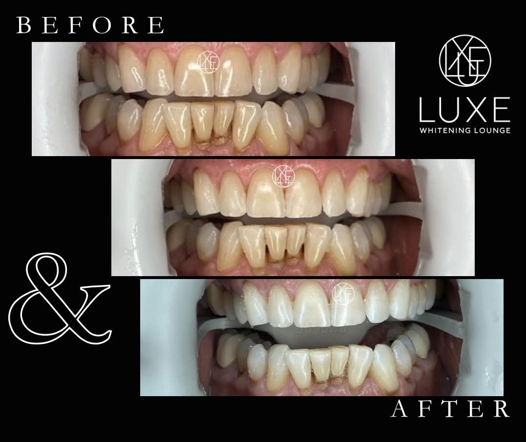 Set of three photographs showing teeth before and after whitening treatments, with a black background and white text indicating 'BEFORE' and 'AFTER'. The top image shows discolored teeth, the middle image shows some whitening progress, and the bottom